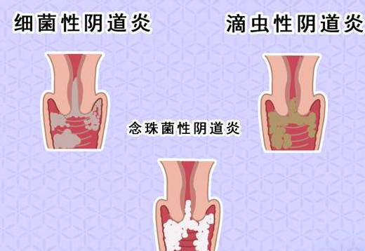 阴道分泌物香蕉视频下载地址剖析什么是细菌性阴道炎