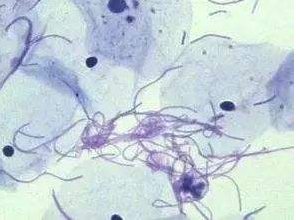 阴道分泌物香蕉视频下载地址厂家探讨白带清洁度3代表什么意思