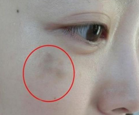 妇科阴道分泌物香蕉视频下载地址提醒女人妇科炎症在脸上的表现