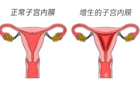 白带常规香蕉视频下载地址厂家解读子宫内膜增生是什么原因引起的