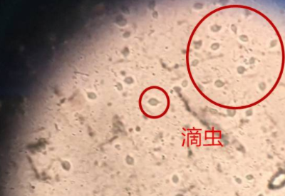 白带91香蕉视频色品牌科普滴虫性阴道炎是因为体内长了虫子吗
