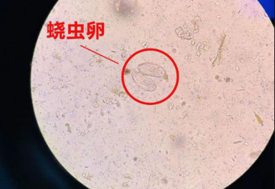 阴道分泌物香蕉视频下载地址警惕外阴绕虫病易在儿童身上出现